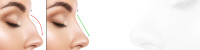 Enhancing Your Natural Beauty With Rhinoplasty In Essex