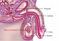 Best Prostate Surgery in Okhla | Call Now: +91-9870271011