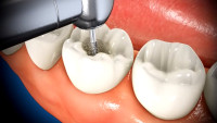 Root canal treatment in Islamabad