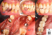 Dental Implants Treatment in Coimbatore | Coimbatore Dental Foundation
