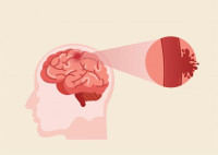 Stroke Treatment in Saket