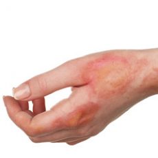 Burn Reconstructive Surgery Dubai